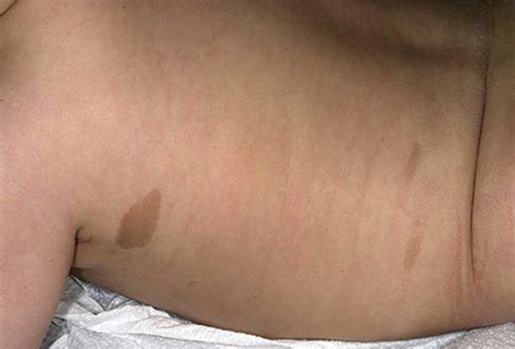 Kaffee mit milch café au lait. Café au Lait Spots, Macules, In Babies, Adults, On Face ...