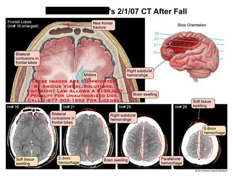 AMICUS Illustration Of Amicus Injury Brain Head CT Fall Frontal Lobes
