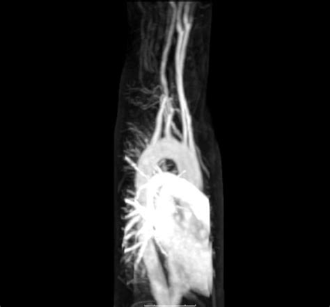 Magnetic Resonance Angiography Of Aberrant Subclavian Artery X Ray