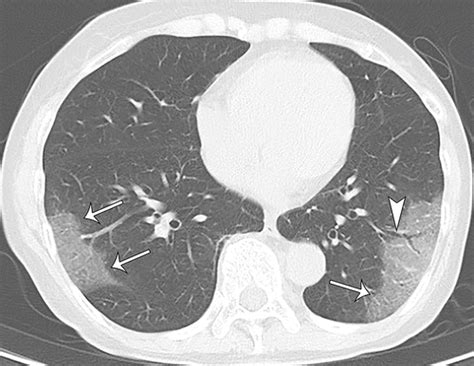 Chest Ct Findings In Cases From The Cruise Ship Diamond Princess With