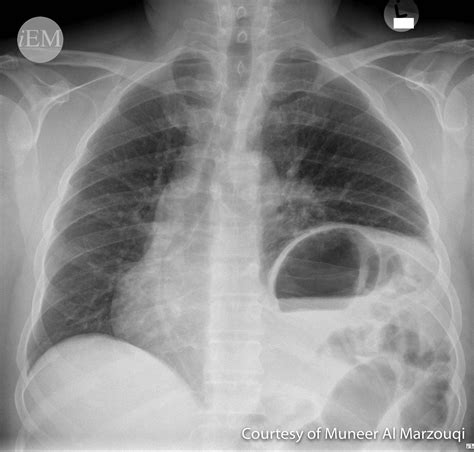 153 Diaphragmatic Hernia 3 Emergency Medicine Clinical Images And