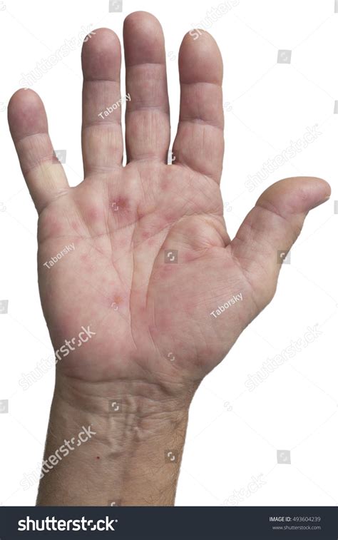 Hand Foot Mouth Disease Hfmd Palm Stock Photo 493604239 Shutterstock