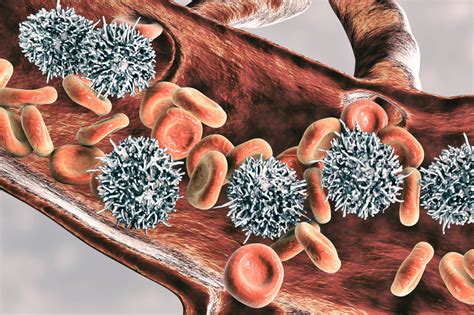 Hairy Cell Leukemia Cladribine With Concurrent Rituximab May Improve