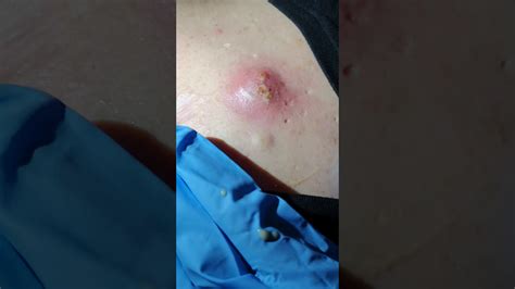 The Biggest Pimple Pop Of Exploding Spot Pimple Cyst Popping