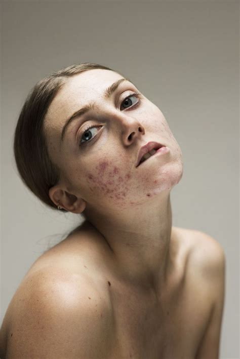 Photographs Of Bare Faced Women With Common Skin Conditions Celebrate
