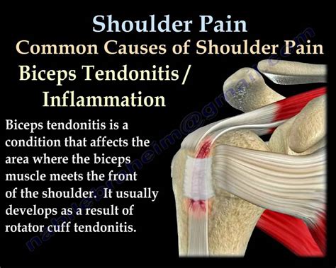 Shoulder Pain Everything You Need To Know Dr Nabil Ebraheim Youtube