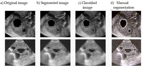 Follicle Detection And Ovarian Classification In Digital Ultrasound