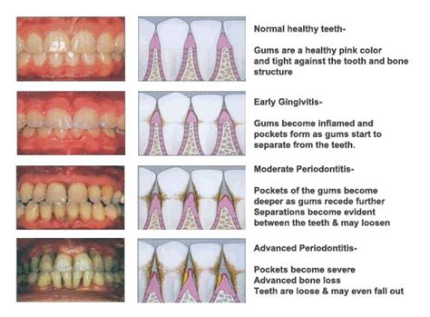 What Are Gingivitis And Gum Disease Dr Nechupadam Dental Clinic