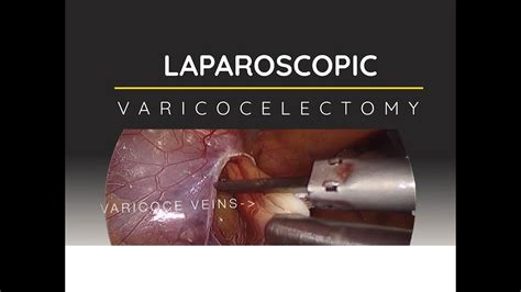 Varicocelectomy Procedure