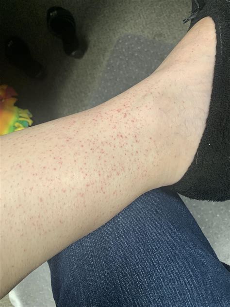 What Is This These Red Spots Will Randomly Show Up On Both Ankles Every Few Months And Last For