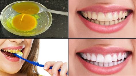 Home Remedy To Remove Stains And Whiten Your Teeth Natural Teeth