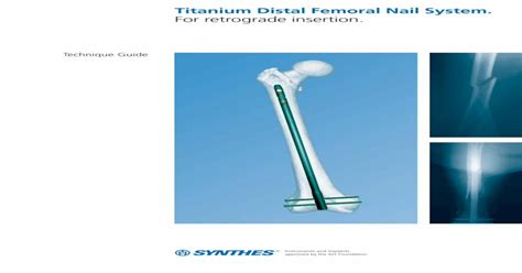 Titanium Distal Femoral Nail System For Retrograde Insertionsynthes