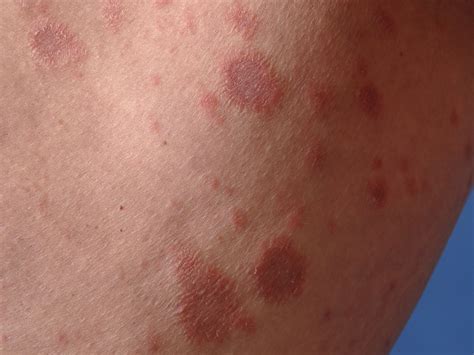The exact cause is unknown. Pityriasis rosea