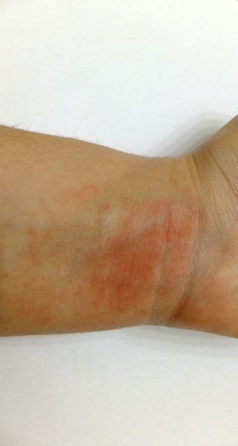 How To Treat Heat Rash Aka That Very Itchy Red Rash You Only Get In