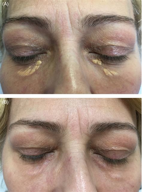 Surgery Xanthelasma Before And After