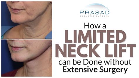 Why Best Neck Lift Results Require Surgery But A Limited Lift Can Be
