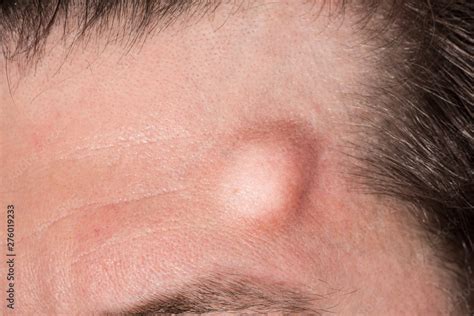 A Large Hematoma Is Seen Up Close On The Forehead Of A Caucasian Man