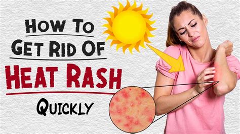 How To Get Rid Of Heat Rash Quickly Home Remedies For Heat Rashes