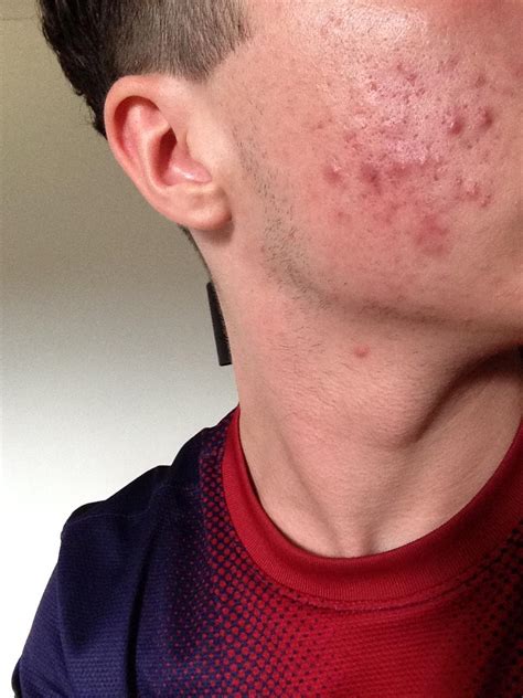 Help With My Acne General Acne Discussion Forum
