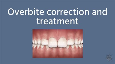 Overbite Correction And Treatment Tim Chauvin Dental Lafayette La Dr