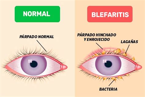 Blefaritis Síntomas Causas Y Tratamiento Con Remedios Caseros Tua