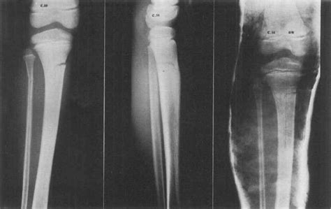 Proximal Tibia Stress Fracture