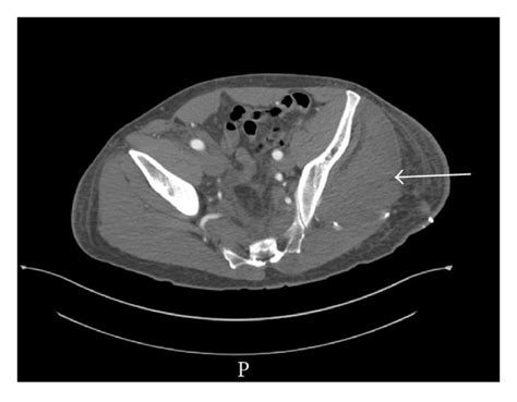 Ct Scan With Iv Contrast Of The Pelvis Showing The Swollen Left Gluteal