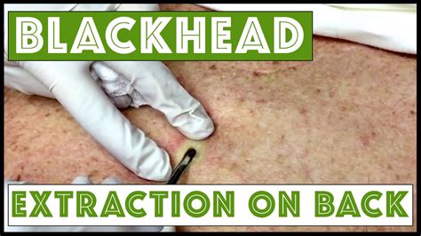 Updated Blackhead Cyst X2 Extraction On The Back For Medical Education