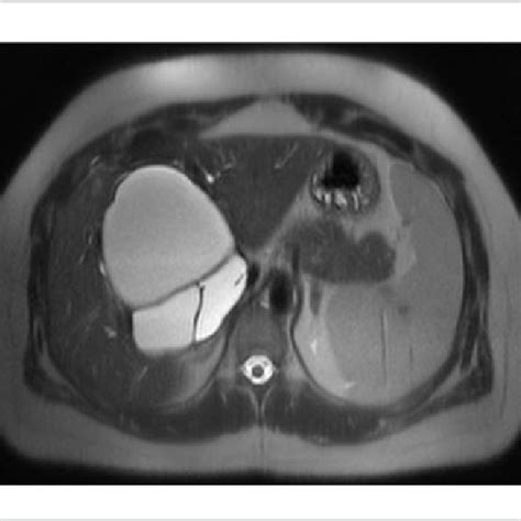 Mri Of The Abdomen Horizontal Section Multiple Cysts Of The Liver