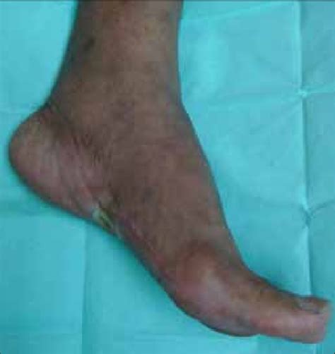 Mr As Foot At 1 Year Follow Up Note The Fasciotomy Site Scar The