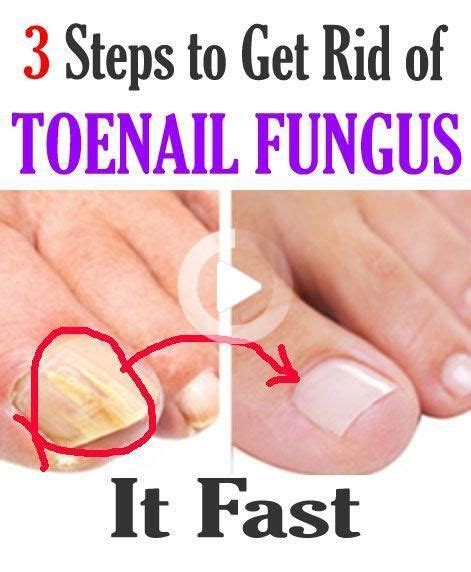 3 Steps To Get Rid Of Toenail Fungus Toenail Fungus Remedies Nail