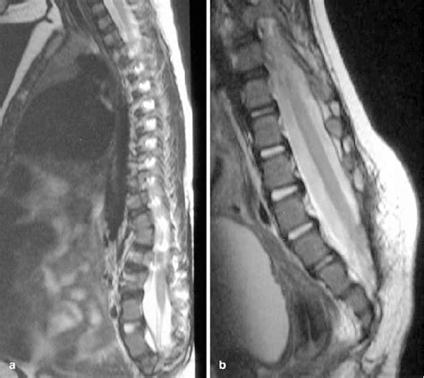 A B Tethered Spinal Cord After Definitive Separation Has Been