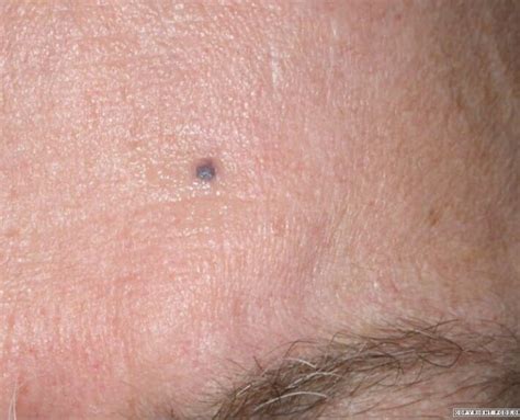 Elevated Skin Lesions