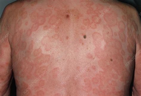 Erythema Multiforme Skin Rash On Back Of Male Stock Image M1500086