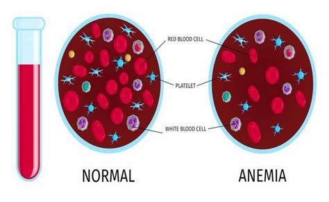 symptoms causes and complications of anaemia or anemia