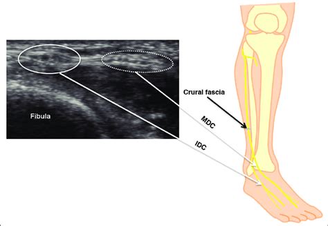 Llustration Of Superficial Peroneal Nerve Spn Branches And Ultrasound
