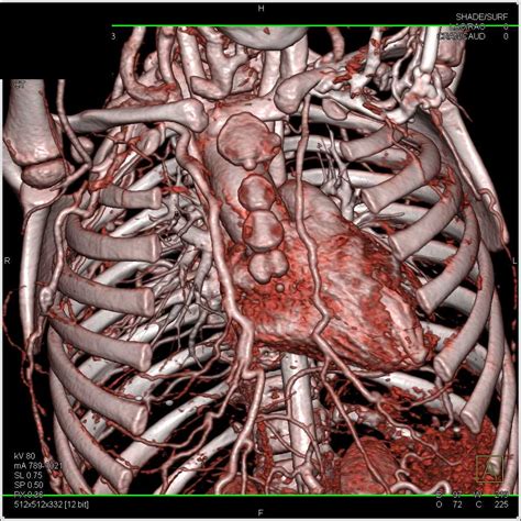 Coarctation Of The Aorta With Extensive Collaterals Chest Case