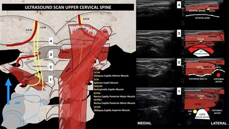 Ultrasound Scan Of The Occipital And Upper Cervical Region Annals Of