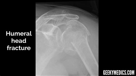 Shoulder X Ray Interpretation Radiology Geeky Medics