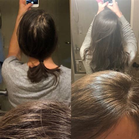 Real Talk Postpartum Hair Loss Lets Live And Learn