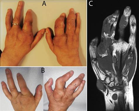 Massive Nodulous Lesions On Hands And Feet In A Ra Patient And