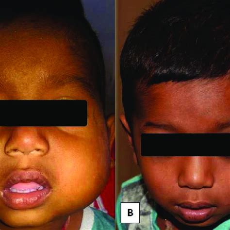 Pdf Parotid Tuberculosis In A Young Child Causing Moth Eaten