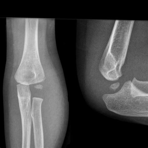 Utah Pediatric Radiology Case Of The Week 29 Month Old With Elbow Pain