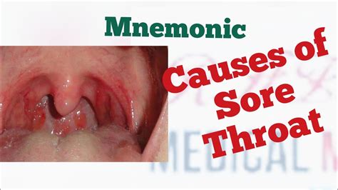 Causes Of Sore Throat Mnemonic Youtube