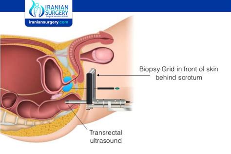 Prostate Biopsy Recovery Prostate Needle Biopsy Recovery Iranian Surgery