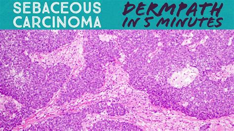 Sebaceous Carcinoma Dermpath In 5 Minutes Pathology Dermatology