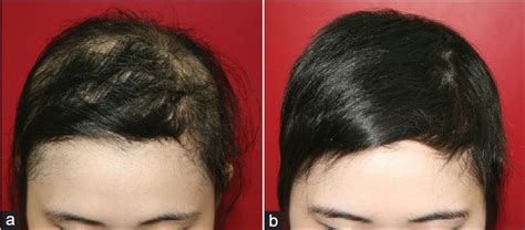 Alopecia Diffusa Alopecia Areata Tipologie Diagnosi Cause E Cure