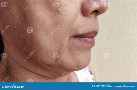 The Flabbiness Adipose Sagging And Wrinkles Flabby And Dullness On The