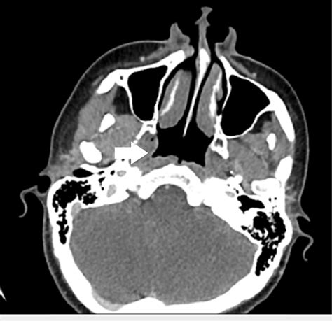 Axial Ct Image Of The Nasopharynx An Axial Ct Image Of The Nasopharynx
