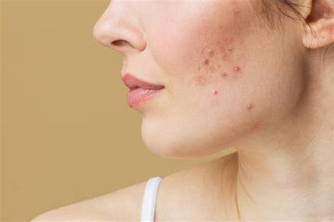 How To Get Rid Of Red Spots On Skin Be Beautiful India